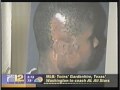 Total Ear Reconstruction Microtia For Young African Girl #microtiarepair