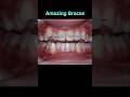 Her teeth are very beautiful but crooked. Braces for a perfect smile. #braces #orthodontist