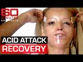 Acid attack survivors inspirational journey to recovery  60 minutes australia