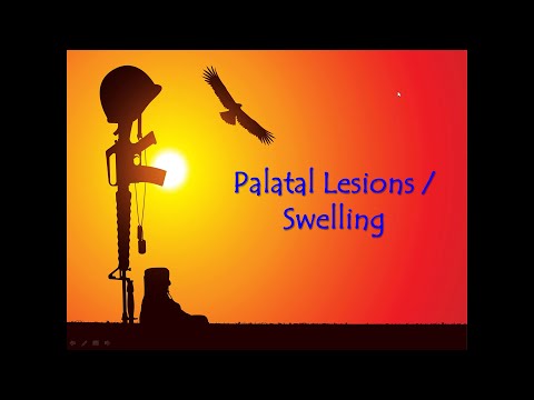Omfs Palatal Swelling