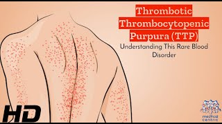 TTP Breakdown: A User-Friendly Guide to Thrombotic Thrombocytopenic Purpura