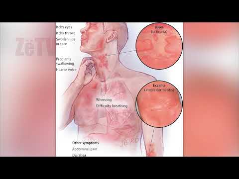 Urtikaria - "Kuriozitete e këshilla mbi shëndetin"