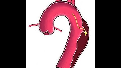 Dissecting Aortic Aneurysms: learn how to classify them and about some of their deadly complications