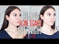 How To Get Rid Of ACNE SCARS OVERNIGHT !!