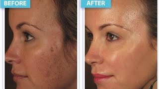 pigment correcting serum