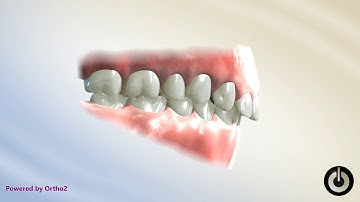 Curve of Spee Correction   Reverse Curve, Upper