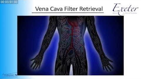 AndraTec Exeter Snare Intravascular Retrieval and Techniques in foreign body retrieval