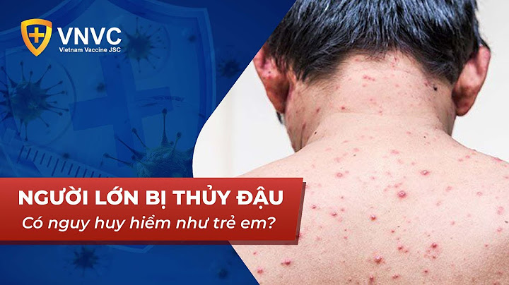 Virus thủy đậu chết ở nhiệt độ bao nhiêu năm 2024