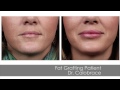 Fat Grafting: A Part of Plastic Surgery Today