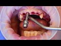 Ceramic dental implants surgery