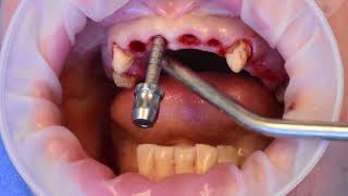 Ceramic Dental Implants Surgery
Watch as Dr. Sanda Moldovan and team perform a Ceramic Dental Implants Surgery. Click the link below for more information!
www.beverlyhillsdentalhealth.com/ceramic-dental-implants-beverly-hills-ca/
www.drsandamoldovan.com
www.twitter.com/drsanda
www.facebook.com/askdrsanda
ABOUT
Dr. Sanda Moldovan is an award-winning periodontist and nutritionist as seen on CBS renowned TV show The Doctors. With a firm belief in health from the inside out, Dr. Moldovan identifies health issues that originate in the mouth to empower patients towards a healthier life. She is a Diplomate of the American Academy of Periodontology and a member of Laser Dentistry and American College of Nutrition. Smile to a healthy future and stay connected with Dr. Moldovan! Ceramic Dental Implants Surgery