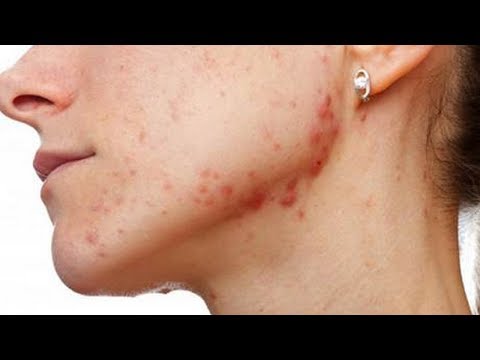  Cystic Acne Home Remedies that Really Work