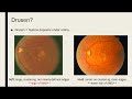 Vision loss and macular degeneration