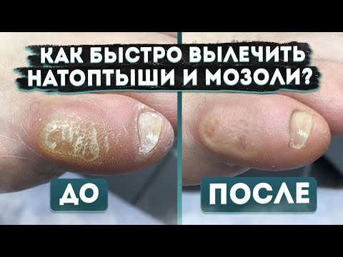 Как мгновенно избавиться от мозолей и натоптышей? | Мнение подолога | Лечение | Диагностика | MEDPED