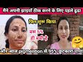 झाइयां हो गयी हैं? जानें झाइयां क्यों होती हैं pigmention 100% ठीक करने के उपाय,तरीके, क्रीम और इलाज
