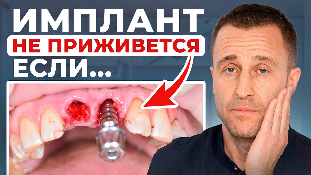 С этим сталкивается 90% людей после имплантации! Самые частые жалобы после установки имплантов!