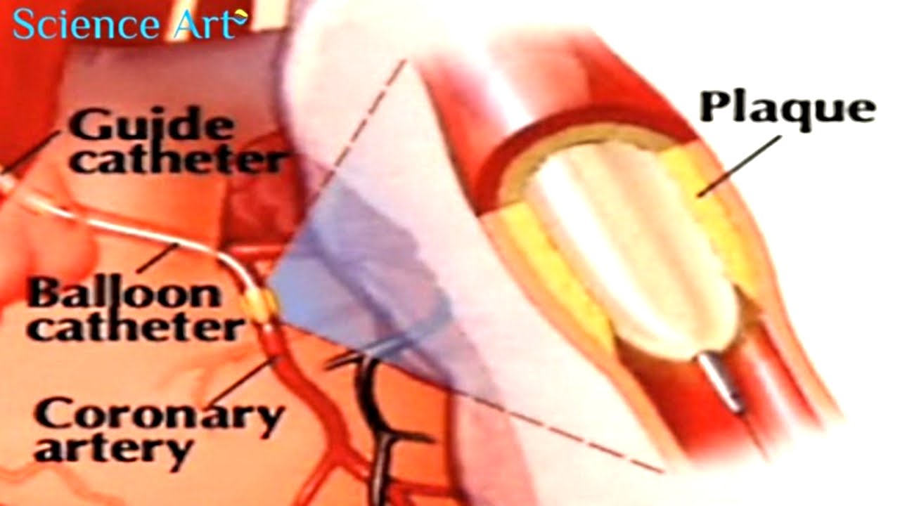 Balloon Angioplasty and Stenting Video Animation - Coronary Angiography and  Heart Stent Procedure - YouTube