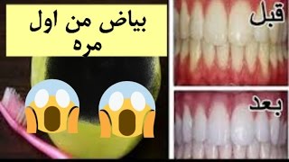 خلطة لتبيض الاسنان /بدون دكتور اسنان النتيجه رهيبه من اول تجربه | Mixture of bleaching teeth