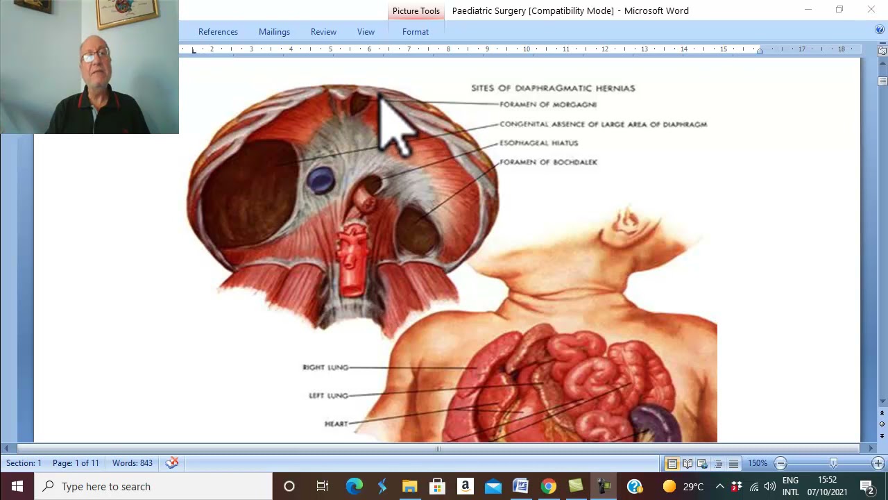 Paediatric Surgery in Arabic 1 (Congenital Diaphragmatic Hernia , part 1 ) , by Dr. Wahdan