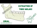 EXTRACTION OF THIRD MOLARS: Odontosection technique in oral surgery - Dr. Han Choi