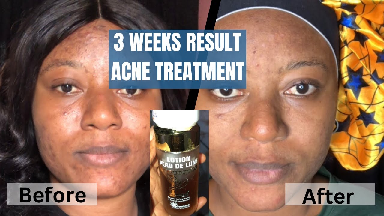 How I Cleared My Acne In 3 weeks with A Cleanser| Peau de lune cleanser ...
