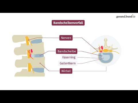 Video: Wo tritt der Bandscheibenvorfall auf?