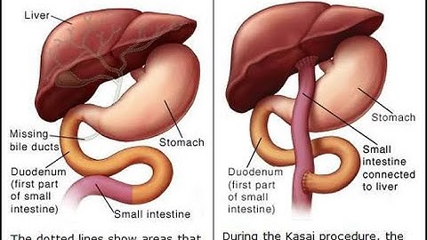 Enterostomy CPT code - simplify medical coding