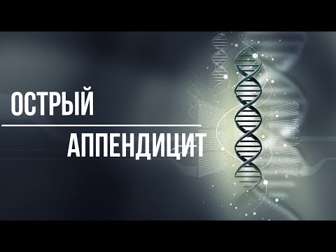 Острый аппендицит