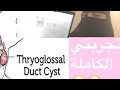 تجربتي الكاملة مع ازالة الكيس الدرقي اللساني Thyroglossal Cyst 