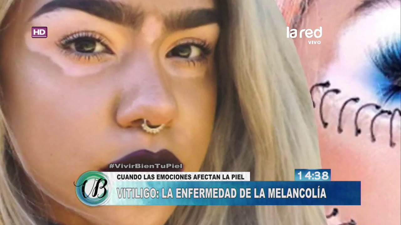 enfermedades de la piel vitiligo fotos