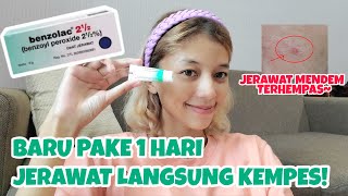 JERAWAT MENDEM LANGSUNG KEMPES PAKE BENZOLAC 2½ | OBAT JERAWAT AMPUH