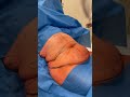 LIPOSAKSIYA ABDOMINOPLASTIKA 975592030