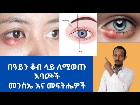 ቪዲዮ: የሌሊት ዓይነ ስውርነት የዓይን መድረቅን ሊያስከትል ይችላል?