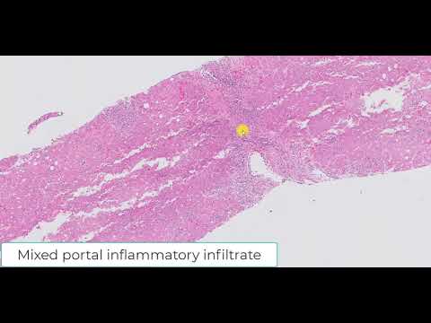 Acute cellular rejection of the liver