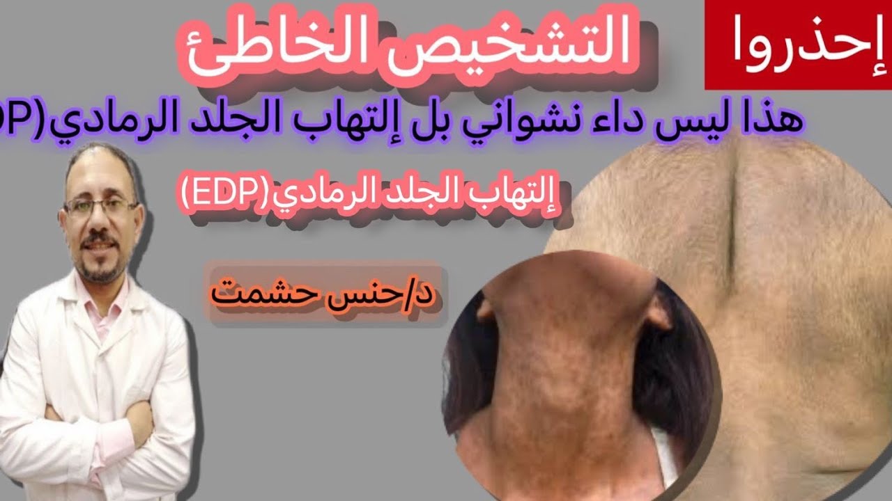أسرار مرض ASHY DERMATOSIS و علاقته بالداء النشواني/أعراض/أسباب/تشخيص/فحوصات و تحاليل/أفضل علاج مثالي