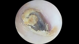 采耳哥-Removal of cerumen impaction from a complexly curved ear canal ｜745