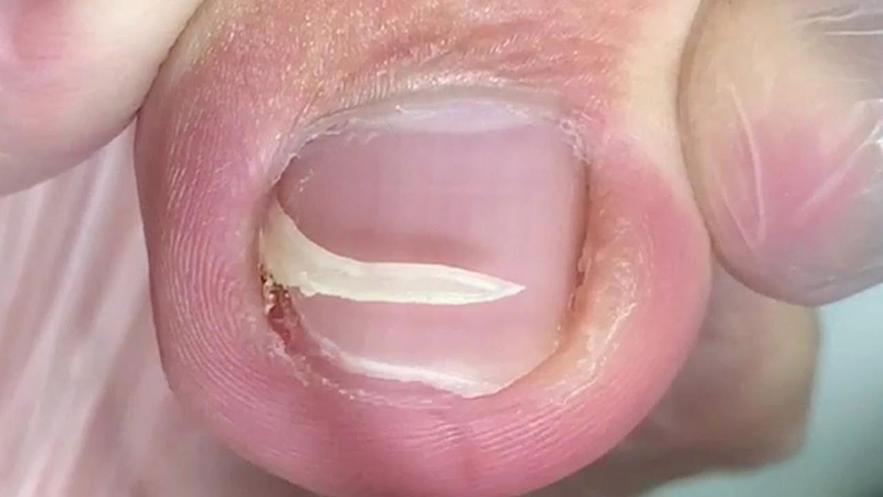 After the toenail was embedded in the flesh, it was removed and the