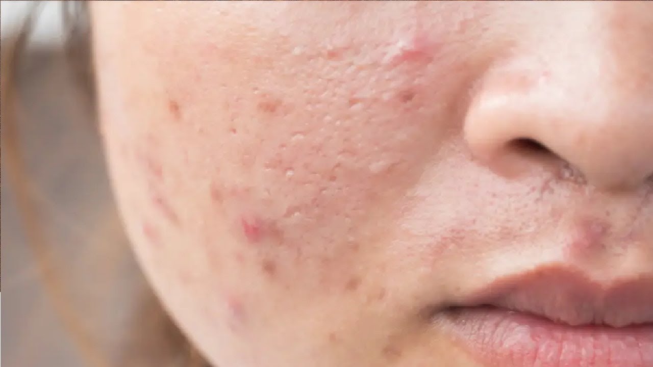 how to get rid of fungal acne without products 