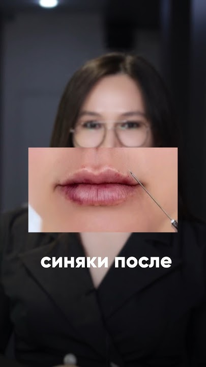 Синяки после увеличения губ- это нормально ? #косметологиямосква # ...