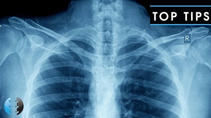 How to Read and Interpret Chest X-Rays: OUR TOP 10 TIPS
