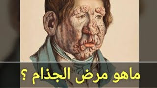 ماهو مرض الجذام 🤔 ؟ أعراضه ؟ تشخيصه ؟ علاج مرض الجذام ؟ لماذا يحدث تشوهات فى الأطراف ؟ Leprosy