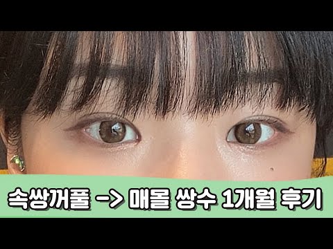 매몰법, <strong>눈매교정</strong>, 앞트임 쌍수 한달 <strong>후기</strong>! 👀 비절개 쌍수후기, 성형후기, 리얼후기, 내돈내함(?), 광고아님