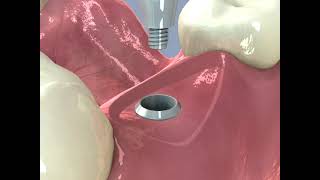 Aplikace implantátů Straumann v Schill Dental Clinic Praha