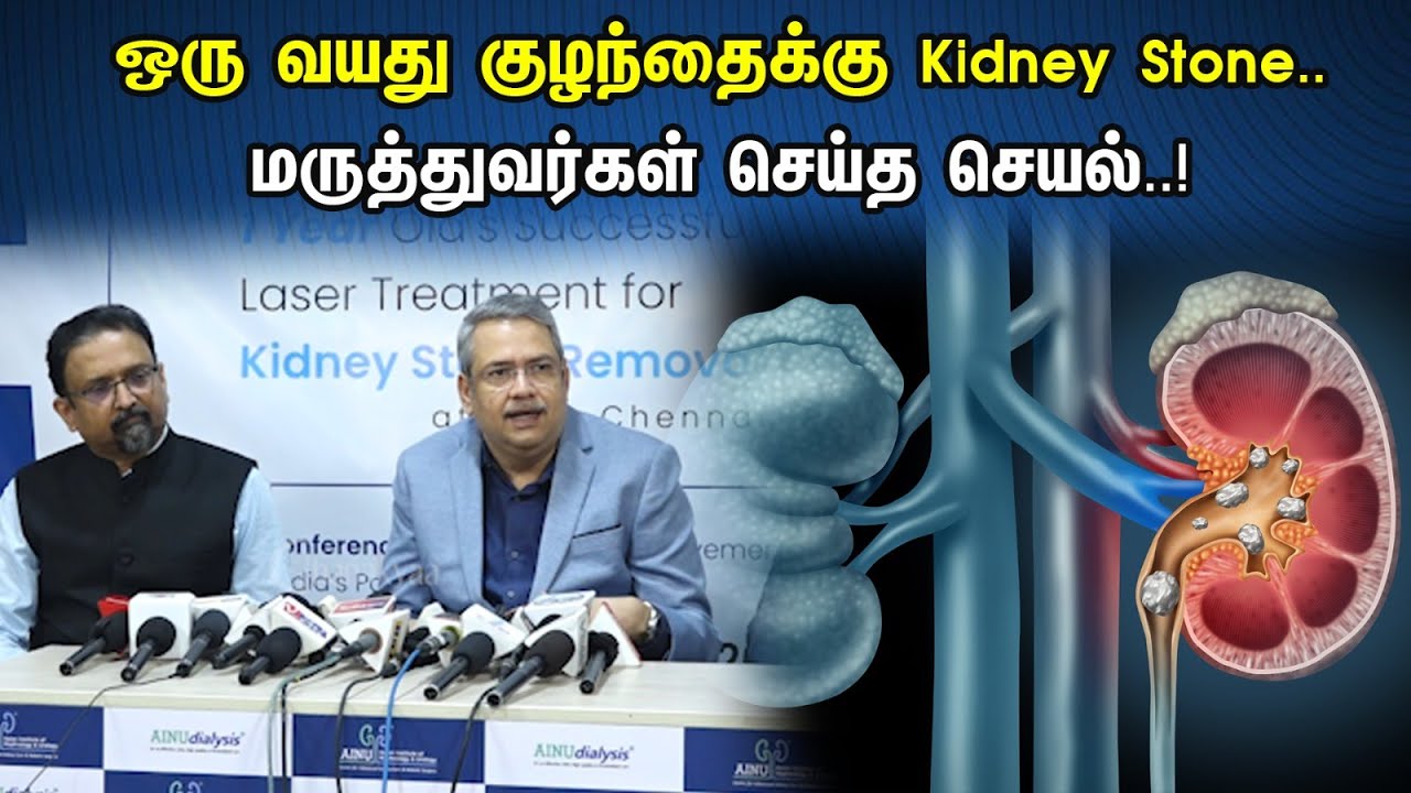 ஒரு வயது குழந்தைக்கு Kidney Stone..மருத்துவர்கள் செய்த செயல் ! | Kidney stone in one year old child.