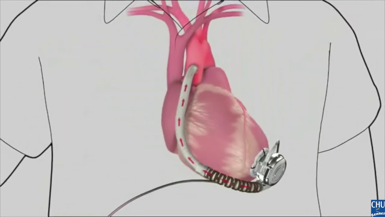 Implantation d'une assistance cardiaque - Heartware - YouTube