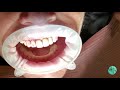 Same Day Dental Implant - Central Valley Dentistry | Phoenix
