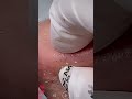 blackhead removal from nose/ old aged blackheads removal