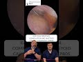 Replying to @Ear Wax Removal Audiology Ass’  EARWAX REMOVAL COMPILATION INC MADTOID CAVITY CLEARANCE
