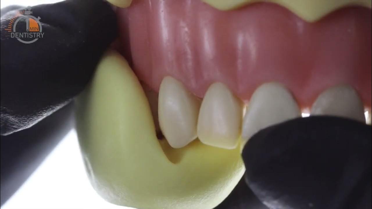 Direct technique for the fabrication of acrylic provisional crown