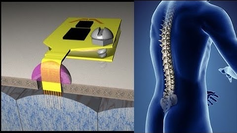 New device in UK to restore bladder control to the paralyzed